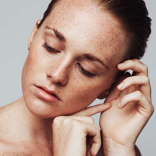 cosmelan & dermamelan depigmentation treatment in sydney at cosmetic injectables by karina