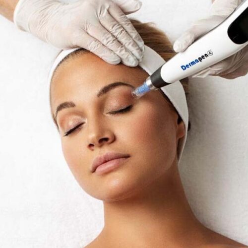 microneedling in sydney at cosmetic injectables by karina
